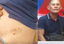 Photographer Bitten by Stray Dog at Bacolod City Public Plaza