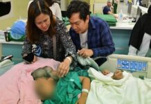 Filipino Conjoined Twins Finally Separated After 18 Hour Life Changing Surgery