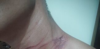 Motorcycle Rider Injured After Hitting Low-Hanging Electric Wire on Road