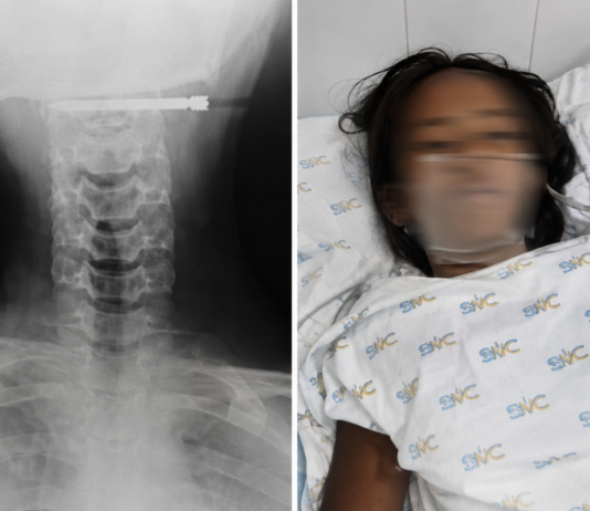 Stray Arrow Injures Student at School in Isabela