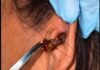 Woman in Romblon Frightened After Finding Large Cockroach Inside Her Ear
