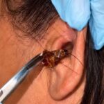 Woman in Romblon Frightened After Finding Large Cockroach Inside Her Ear