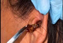 Woman in Romblon Frightened After Finding Large Cockroach Inside Her Ear