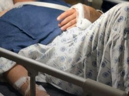 Severed Hand of Camarines Sur Police Officer Successfully Reattached