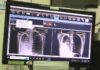 Why staying on TB treatment can be as difficult as getting diagnosed