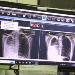 Why staying on TB treatment can be as difficult as getting diagnosed
