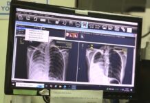 Why staying on TB treatment can be as difficult as getting diagnosed