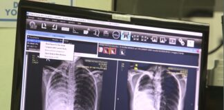 Why staying on TB treatment can be as difficult as getting diagnosed