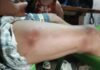 Indigenous Man Searching for Food Survives Crocodile Attack in Palawan
