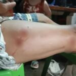 Indigenous Man Searching for Food Survives Crocodile Attack in Palawan