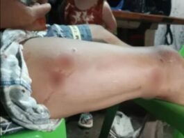Indigenous Man Searching for Food Survives Crocodile Attack in Palawan
