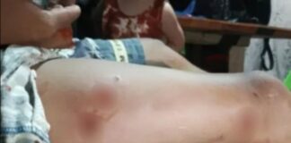Indigenous Man Searching for Food Survives Crocodile Attack in Palawan