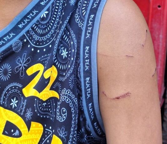 Grade 7 Student Suffers Injuries After Alleged Beating by Teacher in Bacolod