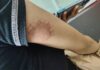 Man Allegedly Bites Girlfriend’s Arm During Argument in Maunlad