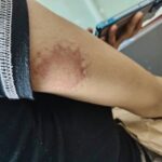 Man Allegedly Bites Girlfriend’s Arm During Argument in Maunlad