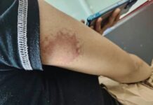 Man Allegedly Bites Girlfriend’s Arm During Argument in Maunlad